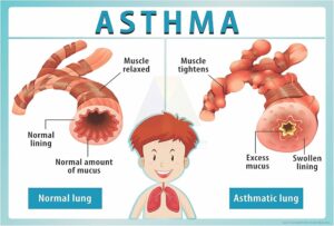 asthma solution