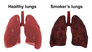 lungs 